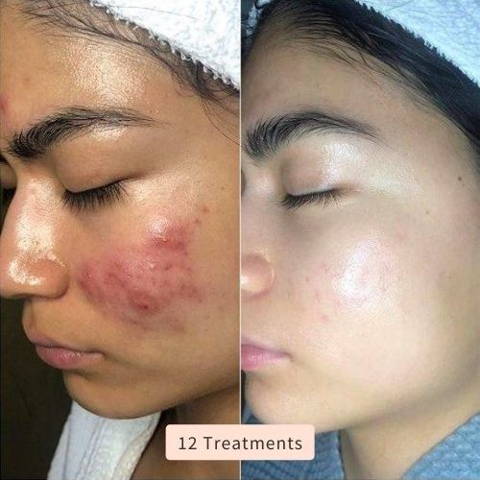 DermaLux | High Frequency Wand – Reduce Acne, Wrinkles & Dark Spots