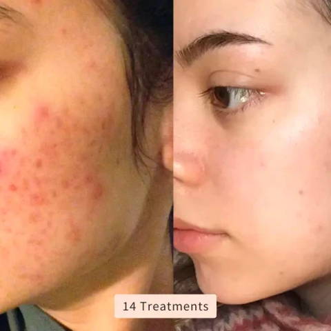 DermaLux | High Frequency Wand – Reduce Acne, Wrinkles & Dark Spots