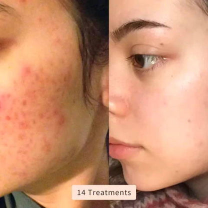 DermaLux | High Frequency Wand – Reduce Acne, Wrinkles & Dark Spots