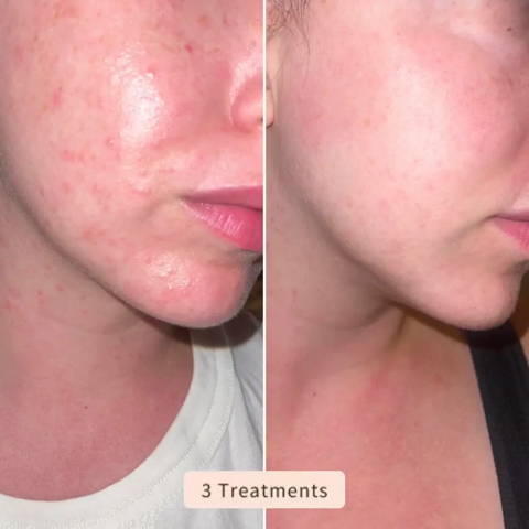 DermaLux | High Frequency Wand – Reduce Acne, Wrinkles & Dark Spots