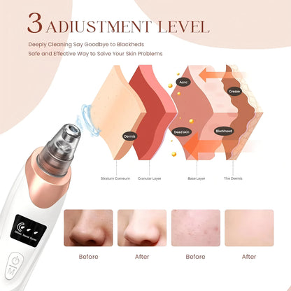 PoreVac | Electric Blackhead Remover – Extract Blackheads, Clean Pores & Reduce Acne