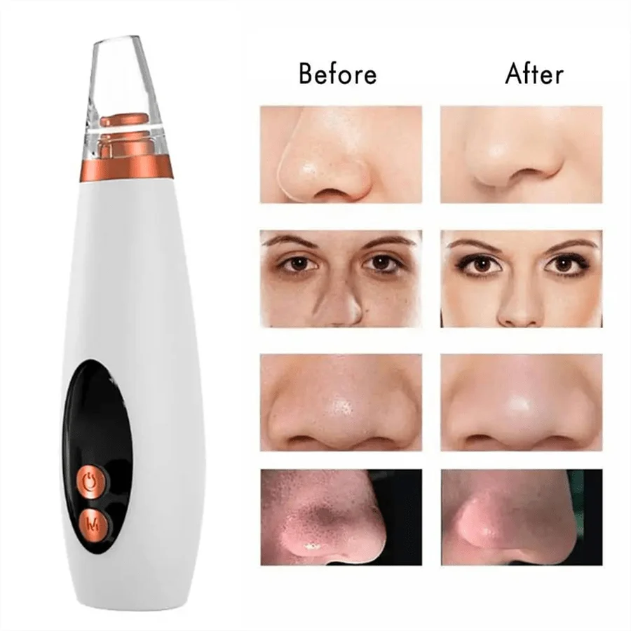 PoreVac | Electric Blackhead Remover – Extract Blackheads, Clean Pores & Reduce Acne