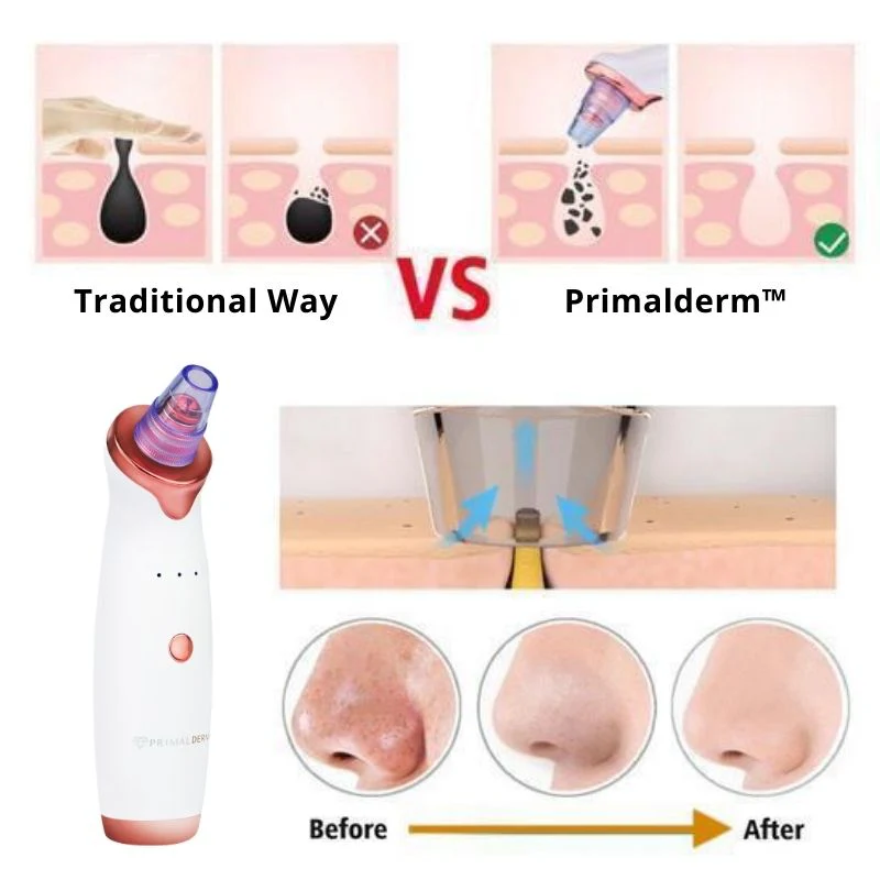 PoreVac | Electric Blackhead Remover – Extract Blackheads, Clean Pores & Reduce Acne